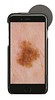HEINE iC1, Digitalt Dermatoskop til iPhone 6/6s