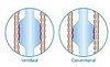 Flexicare Ventiseal tube, endotracheal oral/nasal, murphy eye, cuff st., str. 8,5