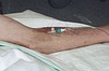 Rudaven transparent, IV bandage, PU film, steril, 6 cm x 8 cm