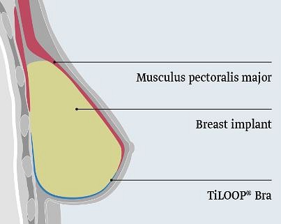 Pfm, TiLOOP Bra, 16 g/m2, steril, small