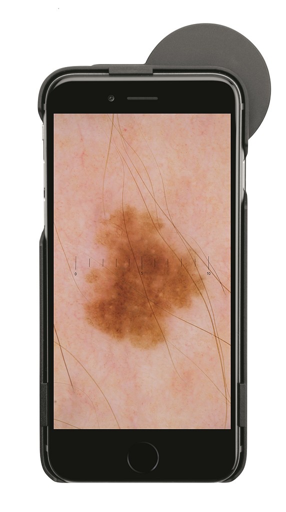HEINE iC1, Digitalt Dermatoskop til iPhone 6/6s