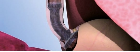 Micro-Tech, Cardi-Umbrella stent, full covered, st., Ø 24 mm L: 120 mm
