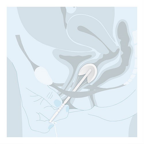 Contrelle, Activgard, skumtampon, startpakke, str 1, 2 og 3