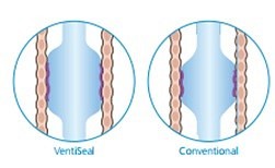 Flexicare Ventiseal tube, endotracheal oral/nasal, murphy eye, cuff st., str 8