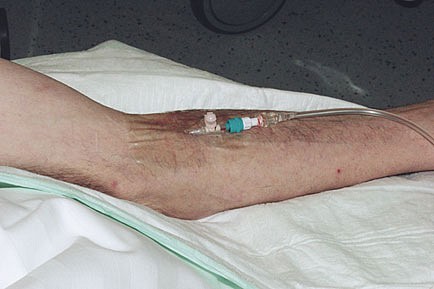 Rudaven transparent, IV bandage, PU film, steril, 6 cm x 8 cm