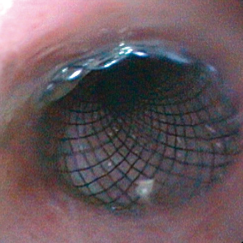 Micro-Tech, Cardia-valve stent, part covered, Ø 20mm L: 120 mm