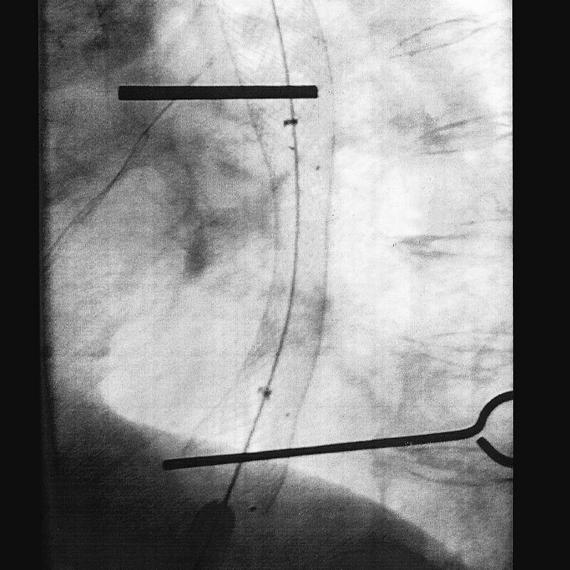 Micro-Tech, Cardia-valve stent, part covered, Ø 20mm L: 120 mm