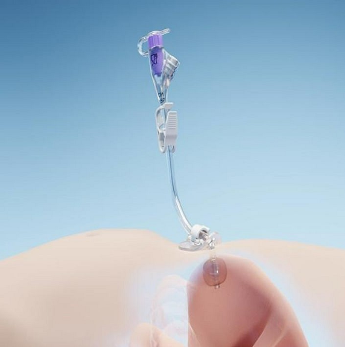 Freka, gastrotube, udskiftningssonde, steril, ch 15
