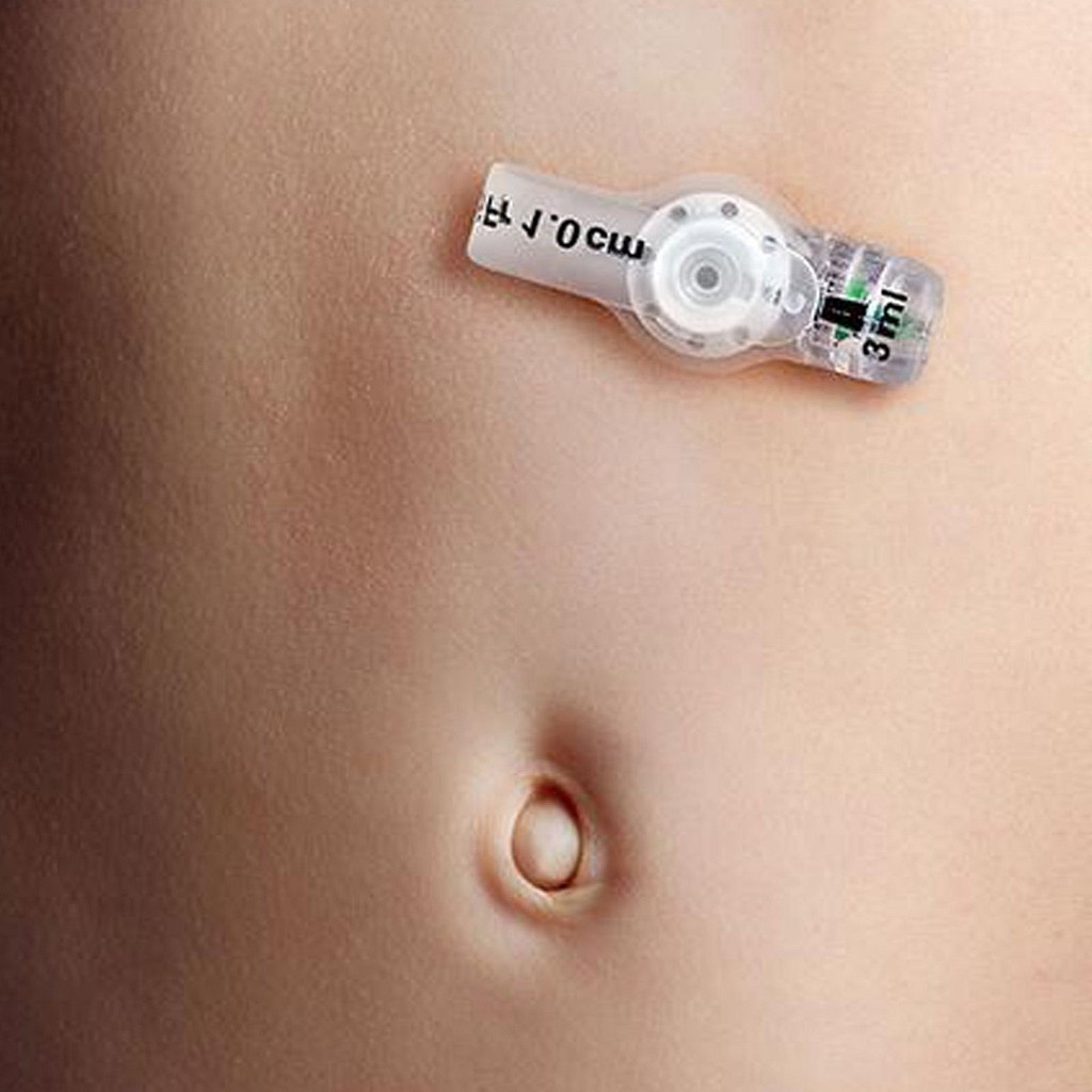 Freka Belly Button, gastrostomiknapsonde, 2,5 cm, steril, FR 16