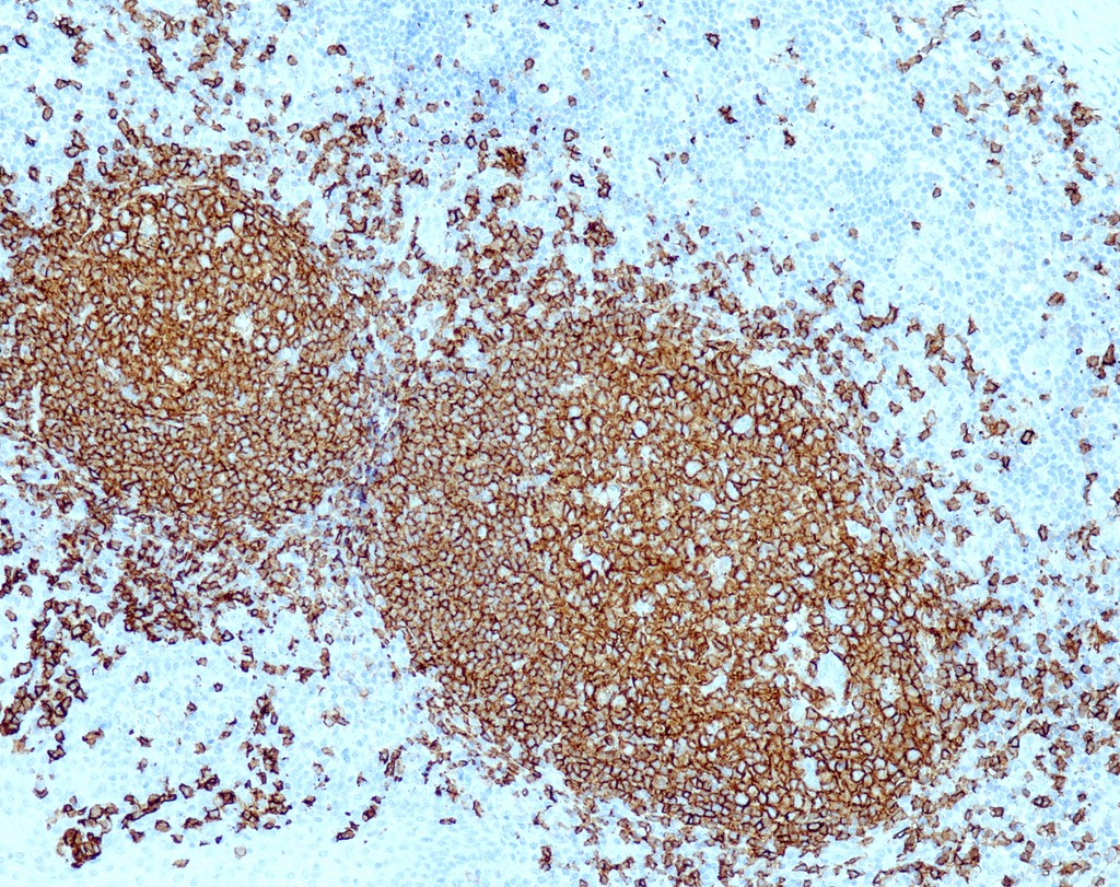 CD20 (QR094) Rb 0,1 ml konsentraatti