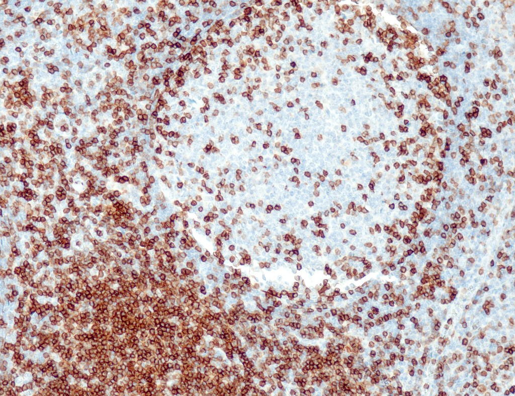 CD5 (QR111) Rb 7 ml RTU liuos