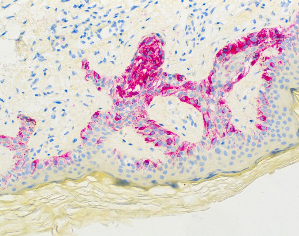 Melanoma (HMB-45) Ms 0,5 ml konsentraatti