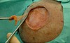 Matriderm Dermal Matrix 148x105x2mm Steril, Tjocklek 2 Mm
