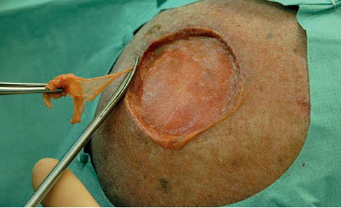 Matriderm Dermal Matrix 297x210x1mm Steril, Tjocklek 1 Mm