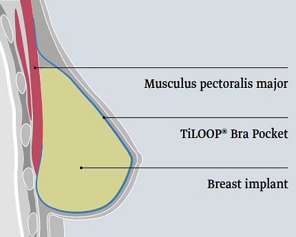 Tiloop Bra pocket Small