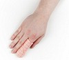 Skumförband Finger/tåförband Polymem S steril