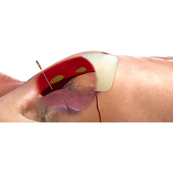 Decompression needle set Tpak 14g
